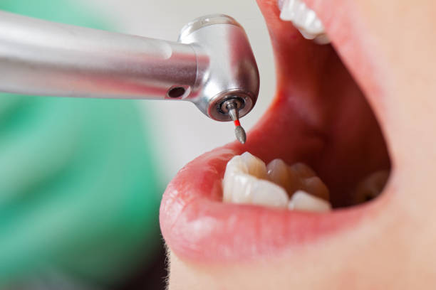 Best Emergency Treatment for Dental Infections or Abscesses in Linda, CA